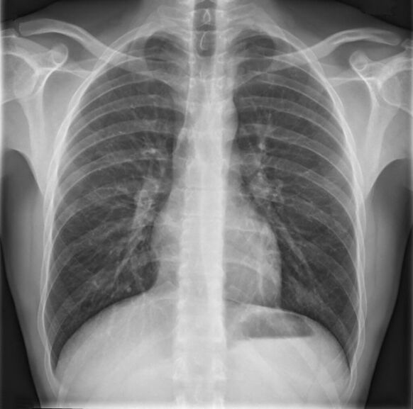 Osteochondrosis of the thoracic spine is diagnosed by radiography