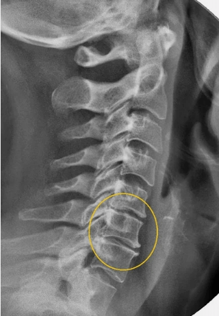 Osteochondrosis of the cervical column on an X radius