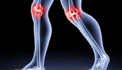Prevention of arthritis development and osteoarthritis