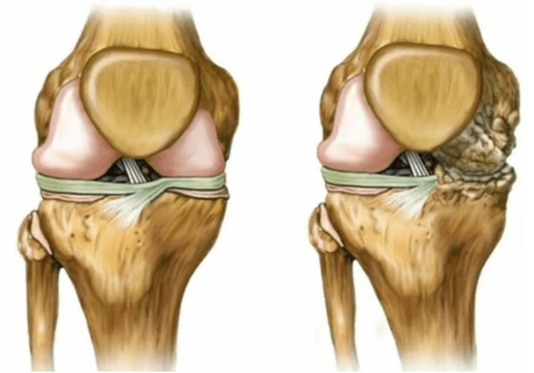 Osteoarthritis stages