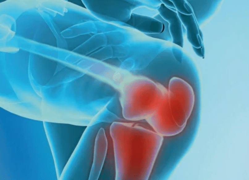 What is osteoarthritis