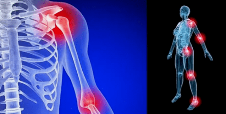 distortion of limbs for osteoarthritis
