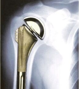 Shoulder arthroplasty for osteoarthritis