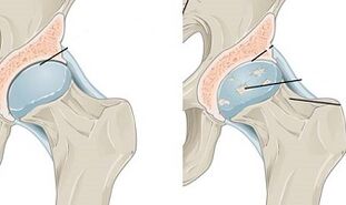 stages of development of osteoarthritis of the hip