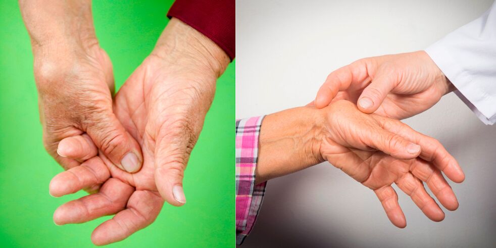 swelling and aching pain are the first signs of arthritis in the hand
