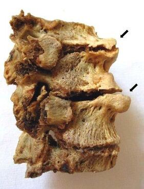 Spinal section affected by osteochondrosis